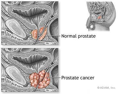Prostate cancer